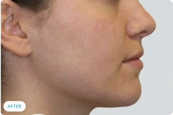 Patient facial profile after airway-focused treatment