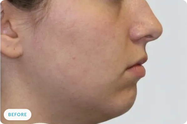 Patient facial profile before airway-focused treatment