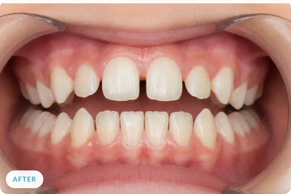 Patient smile after orthodontic expansion treatment