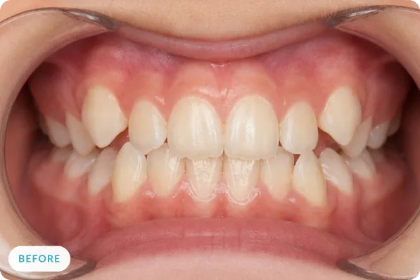 Patient smile before orthodontic expansion treatment