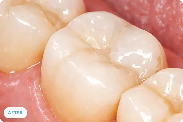 Molar after placement of a tooth-colored metal-free restoration