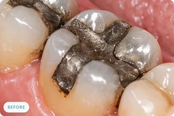 Molar with a metal filling before metal-free restoration