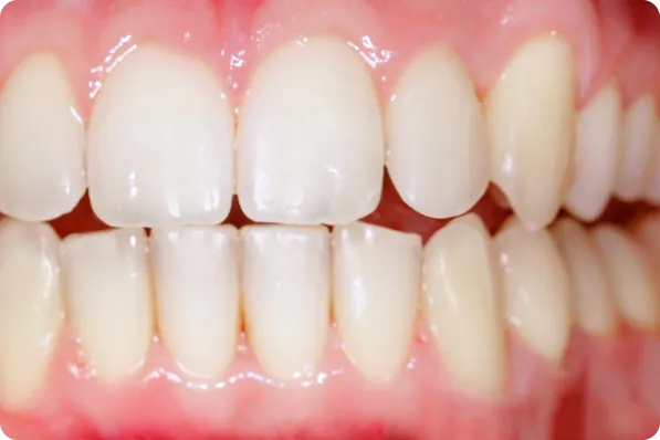 Patient teeth after orthodontic alignment treatment