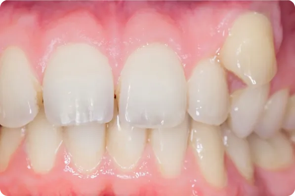 Patient teeth before orthodontic alignment treatment