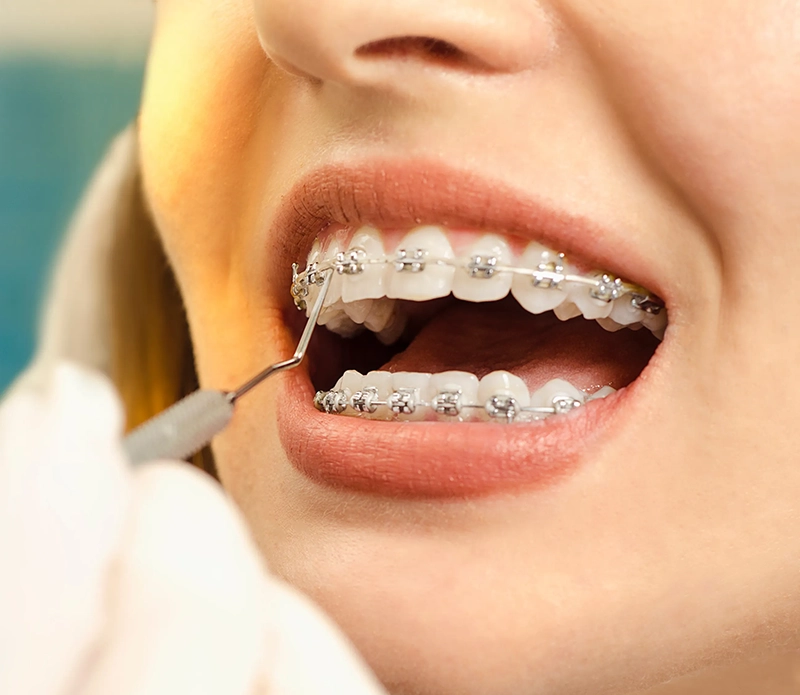Close-up of traditional metal braces