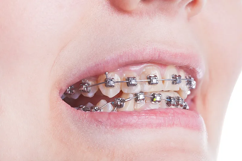 Damon self-ligating braces