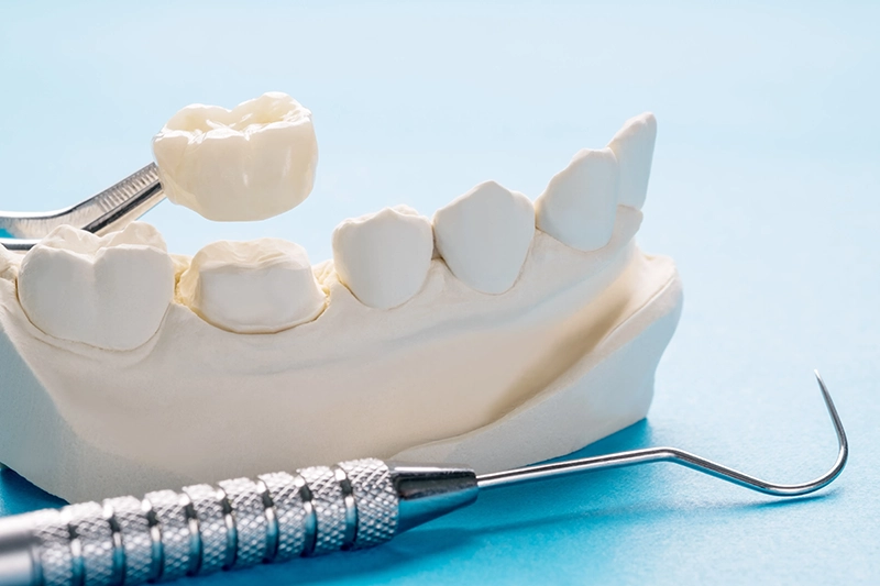 Dental model showing a tooth-colored crown being fitted