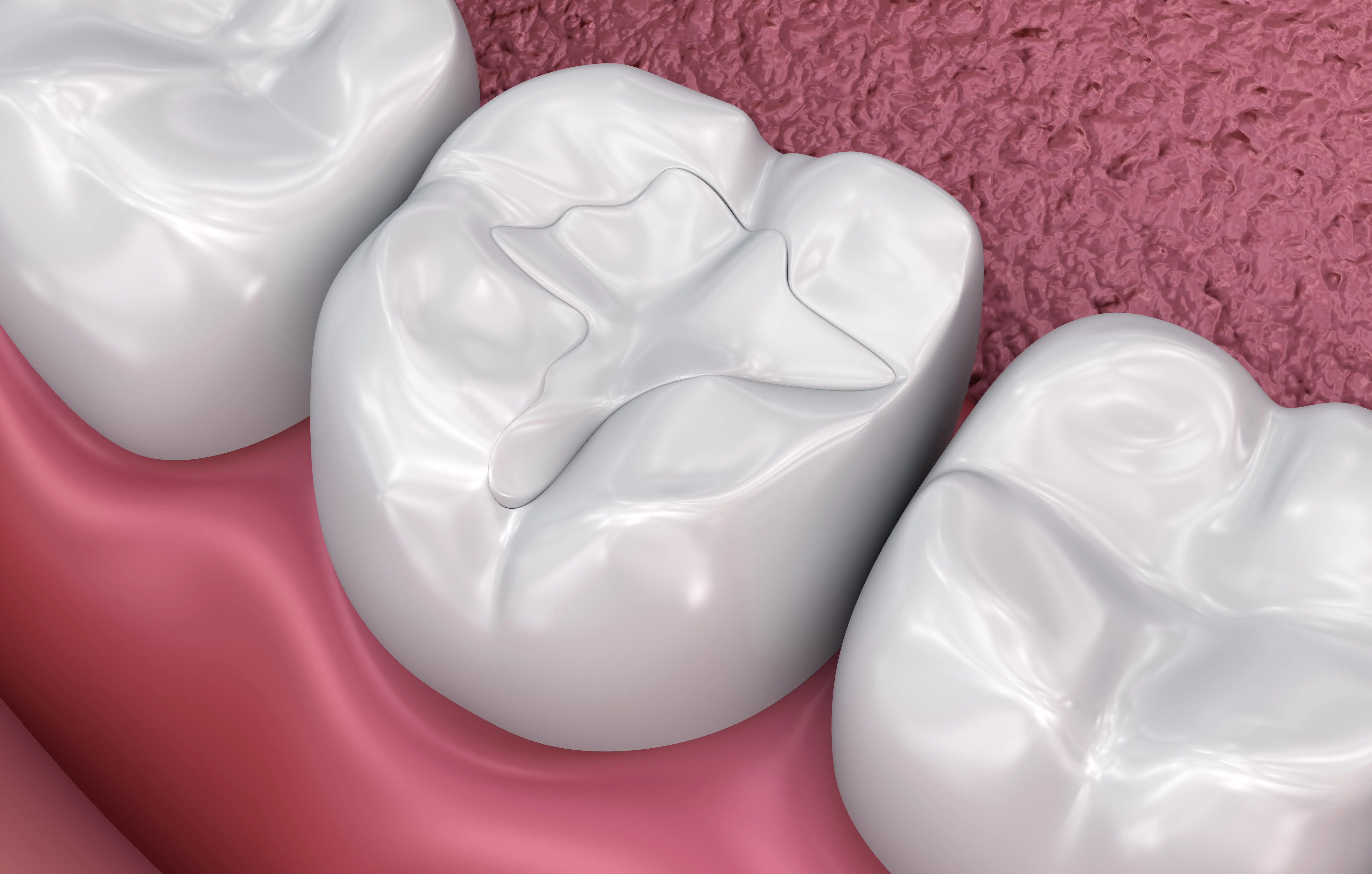 Illustration of a tooth-colored composite filling