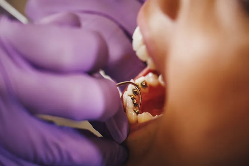 InBrace lingual braces