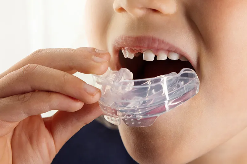 Child placing a clear myofunctional oral appliance to support tongue posture and breathing habits