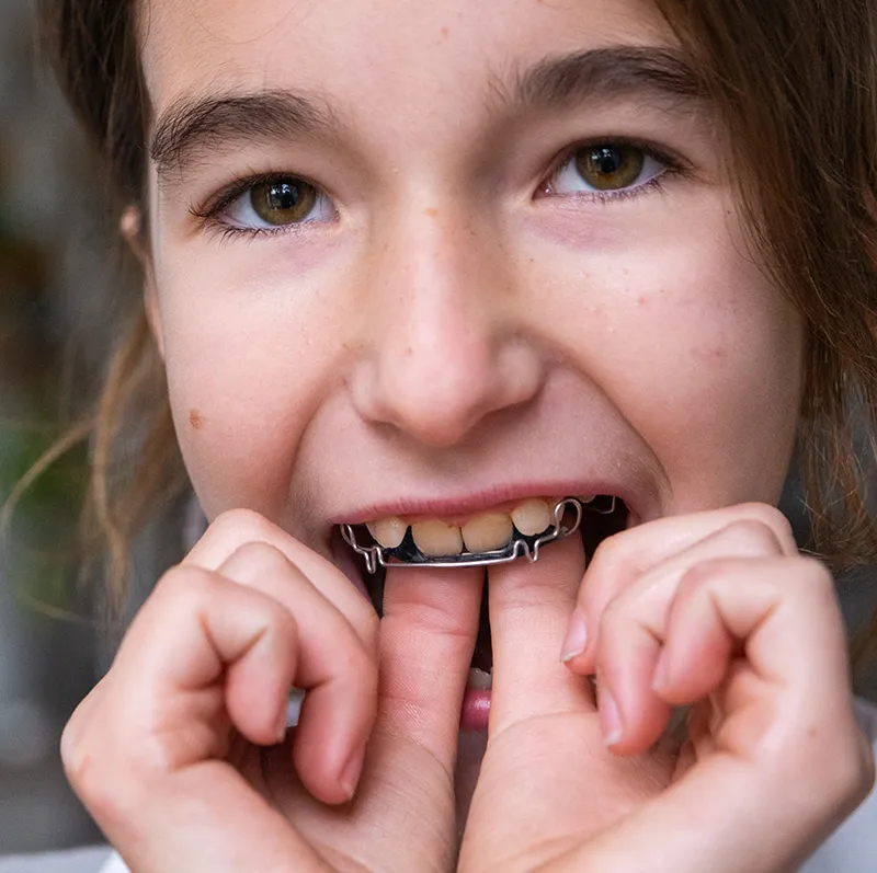 Young patient showing a fixed palatal expander appliance in her mouth