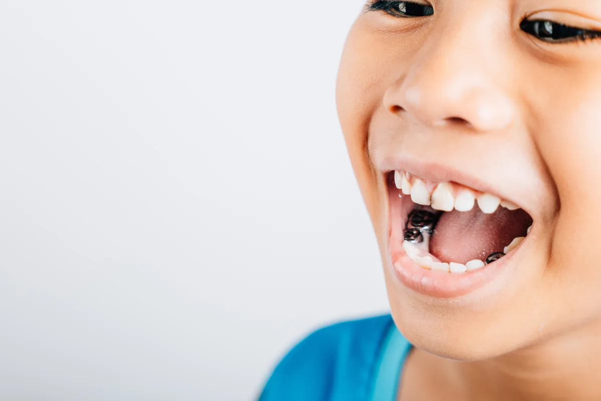 Close-up of a child's open mouth showing a cavity on a baby tooth