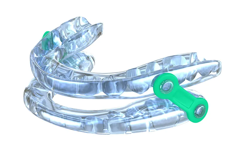 Custom sleep apnea oral appliance