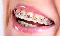 braces