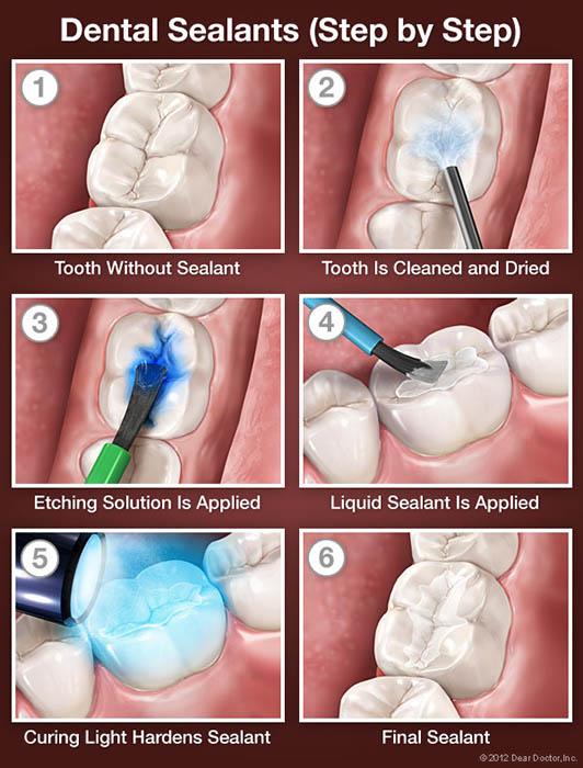 sealants explained in a graphic